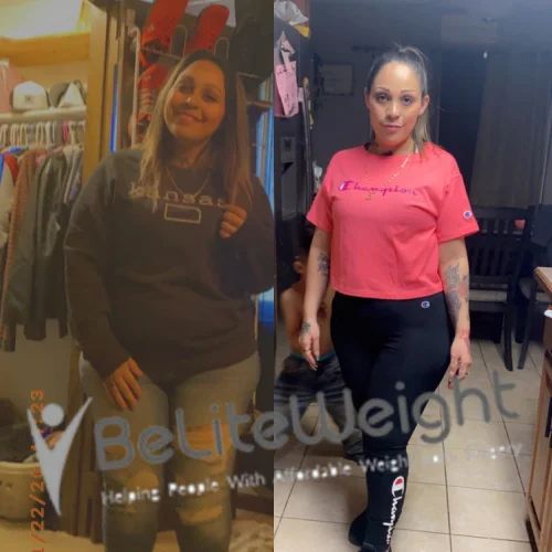 Weight Loss Surgery Before And After
